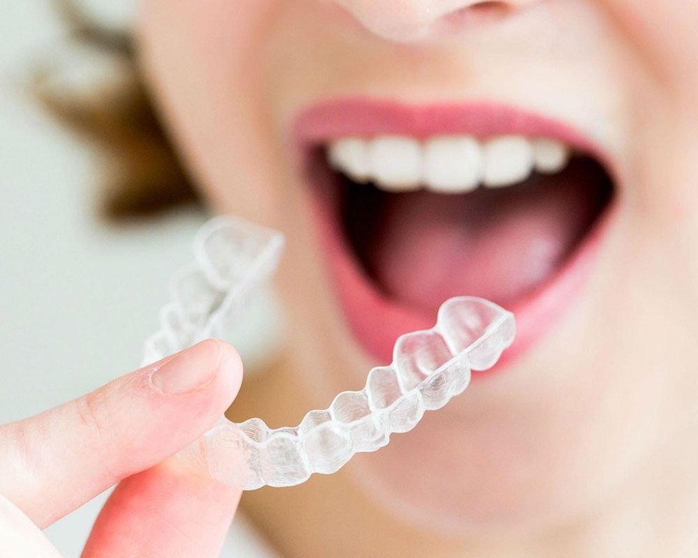 The Benefits of Choosing Invisalign Treatment Over Traditional Braces
