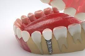 Everything You Need to Know About Dental Implants: A Comprehensive Guide