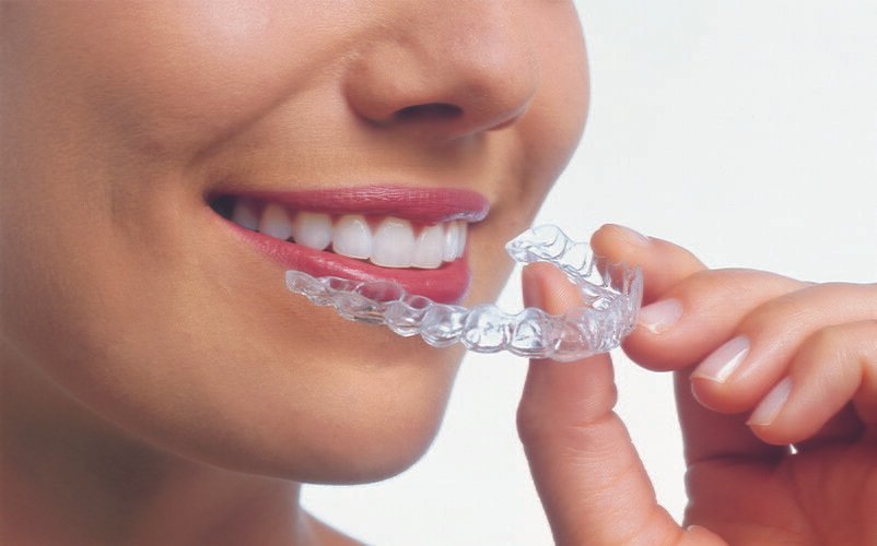 Invisalign