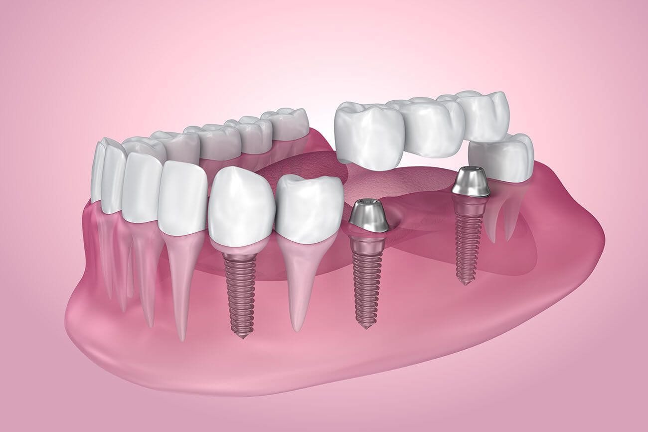 The Benefits of All on 4 Dental Implants
