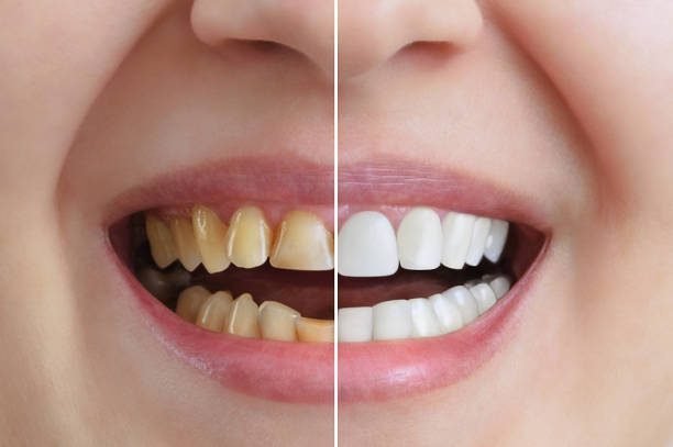 The Top Cosmetic Dental Procedures: Which One Is Right for You?