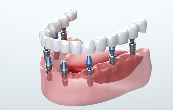 Barrow Dental Aesthetics Clinic: Restoring Your Smile with Dental Implants in Barrow-in-Furness