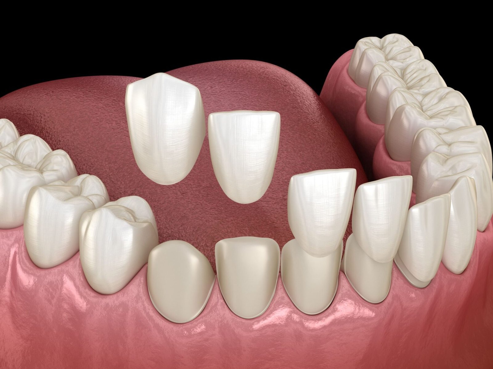 Composite Bonding vs. Porcelain Veneers: Which Is the Right Choice for You?