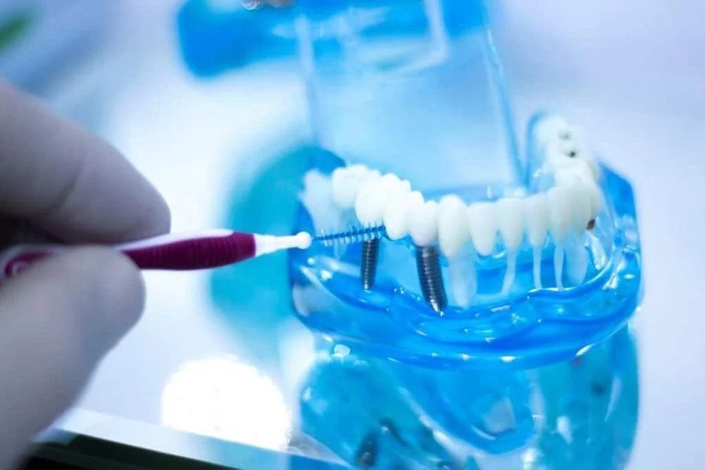 Maintaining Your Dental Implants: Tips for Long-Term Success