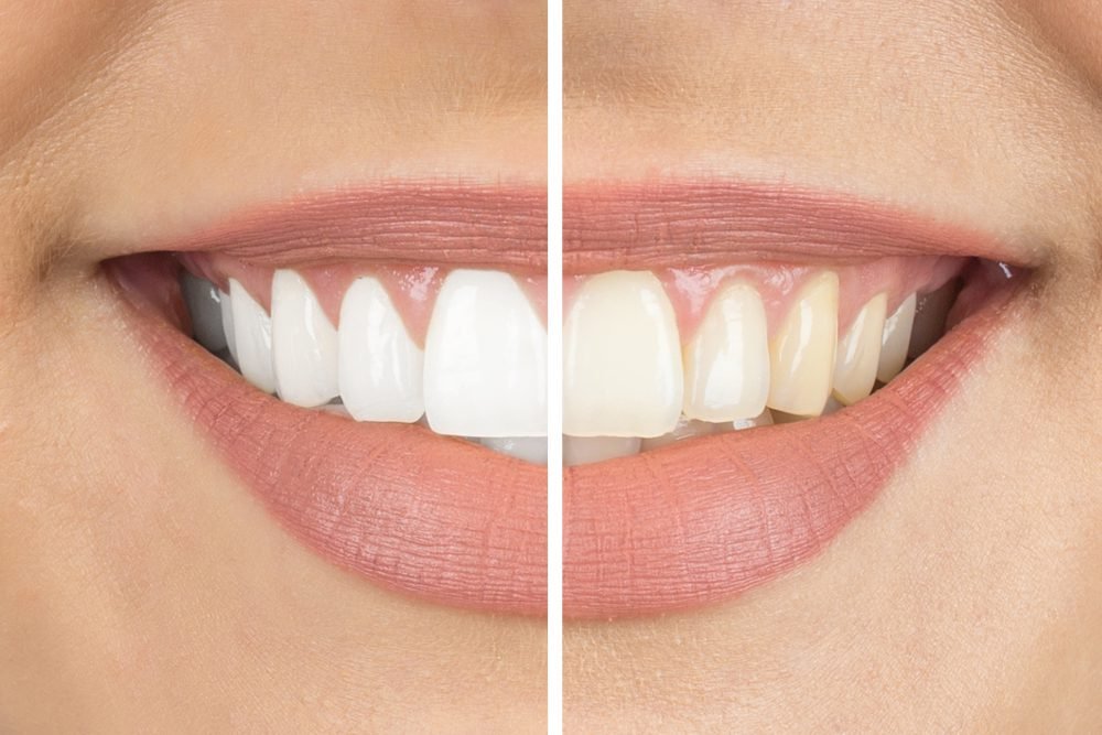 Teeth Whitening 101: How It Works and What You Need to Know