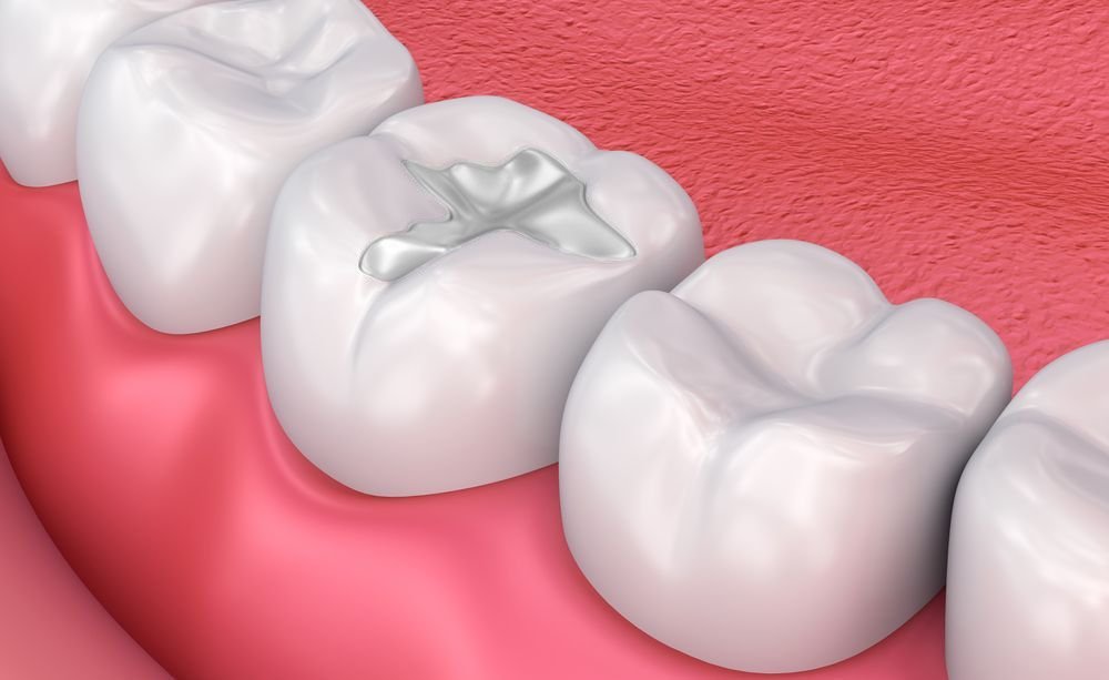 Are Composite Fillings Strong?