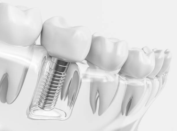Dentures and Implants